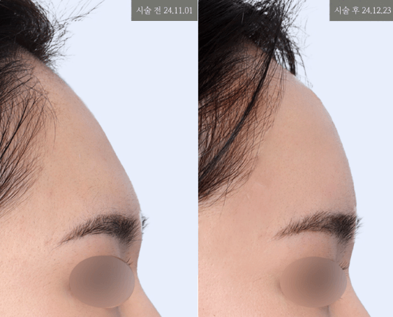Pain-free system with numbing cream and vibration device
